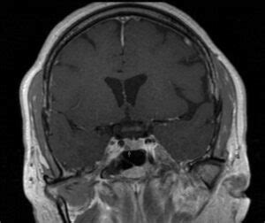 Prolactinoma MRI - My Endo Consult