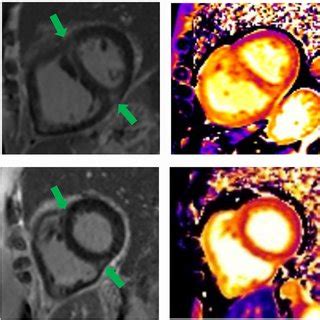 Representative images of two CTEPH patients. A A 55-year-old woman... | Download Scientific Diagram