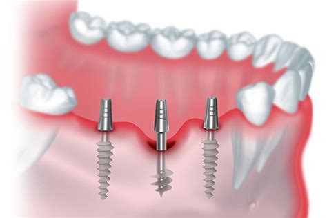 Basal Implants Treatment In Bangalore - Hontistry