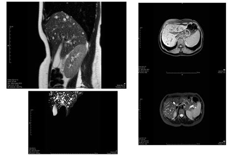 Caroli Disease | International Journal of Clinical & Medical Images