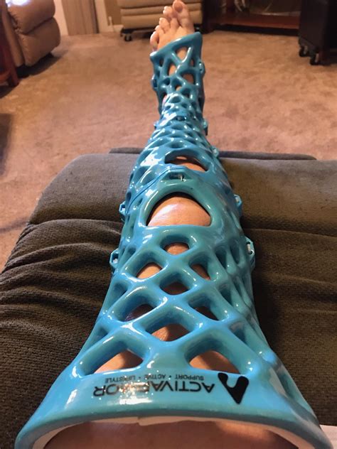 3D printed cast. You can take a shower with it! : r/EngineeringPorn