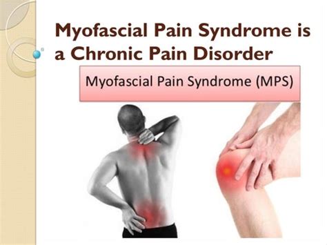 Symptoms of myofascial pain syndrome & treatment by paincarecenter - Issuu