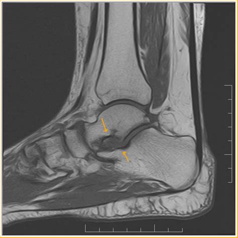 Sinus Tarsi Syndrome : MRI - Sumer's Radiology Blog