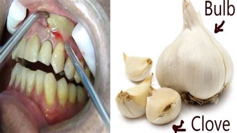 How To Use Garlic For Abscess Tooth - YouTube