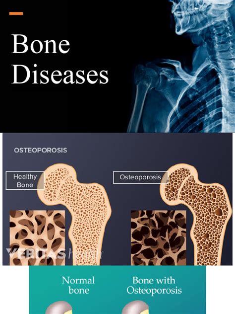 Bone Diseases | PDF