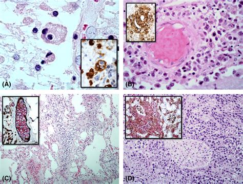 Post-mortem pathological diagnosis of primary B-cell lymphoma of the... | Download Scientific ...