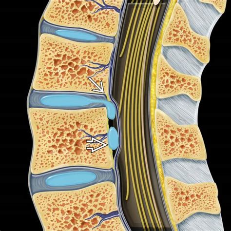 Nomenclature of Degenerative Disc Disease | Radiology Key