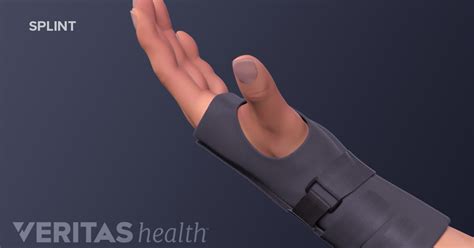 Treating Wrist Tendonitis Without Surgery