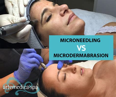 Microdermabrasion vs Microneedling: Which is Best for My Skin?