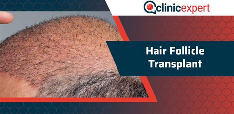 Hair Follicle Transplant | ClinicExpert Healthcare