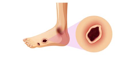 4.-Diabetic-Foot-Infections-Causes-Symptoms,-and-Treatment | OMNI Hospitals