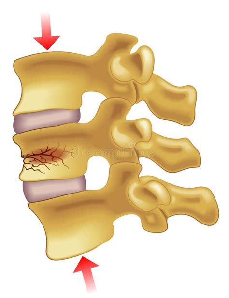 Vertebral Compression Fracture Stock Vector - Illustration of column, menopause: 68077052