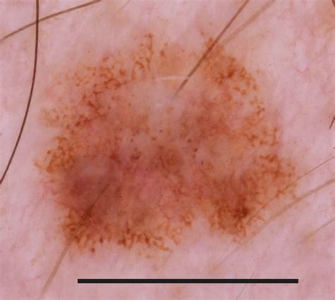 Dermoscopy of Melanocytic Neoplasms: Subpatterns of Dysplastic/Atypical ...