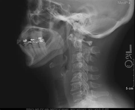 Atlantoaxial Joint Subluxation