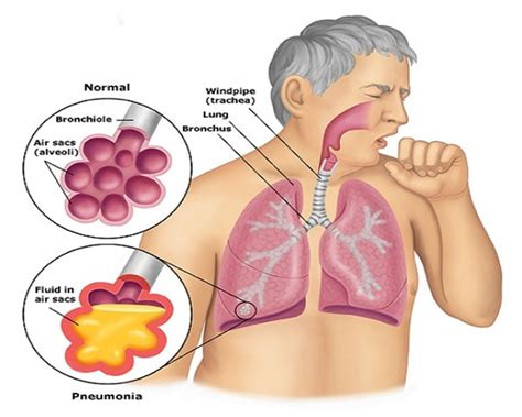 What Causes A Chronic Cough? - Health | Katalay.net