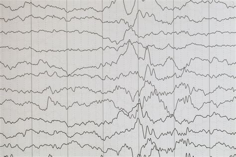 What is a tonic–clonic seizure? — Epilepsy alarms for children and adults with seizures