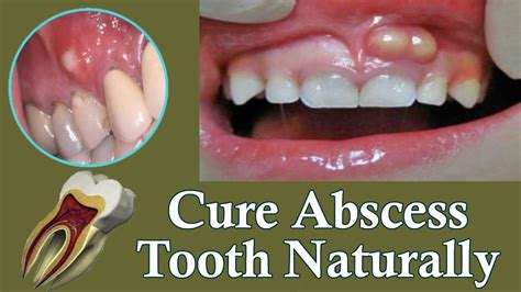 Tooth Abscess Pain