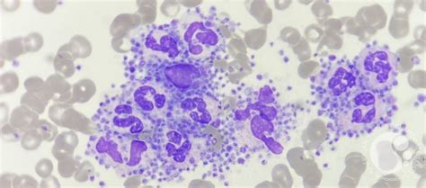 Platelet satellitism around leucocytes 2