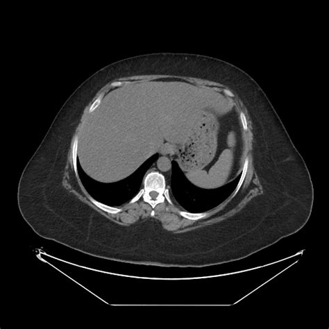 File:Giant umbilical hernia- colon, ileum, and appendix (Radiopaedia 170978-138256 Axial 117 ...