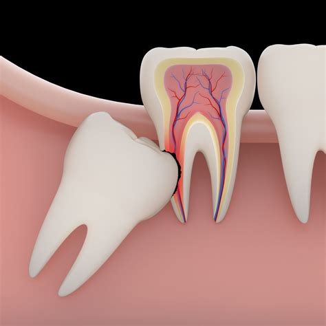 Impacted Wisdom Tooth Removal - Bolingbrook, IL - Extraction