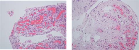 Frontiers | Histopathology of Psoriatic Arthritis Synovium—A Narrative Review