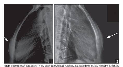 Acute traumatic sternum fracture in a female college hockey player ...