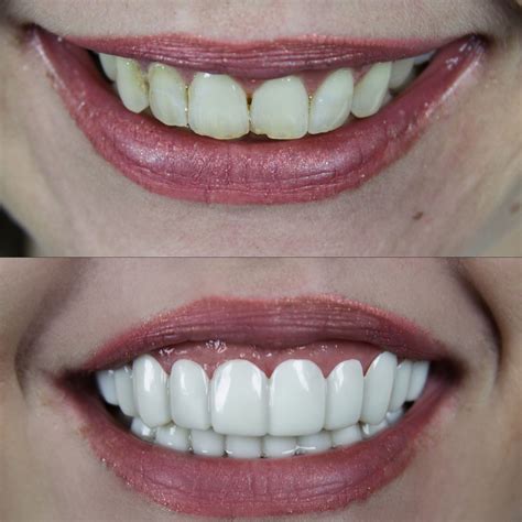 Amazing smile makeover, dental veneers, lab direct, no dentist visit... clip on veneers ...