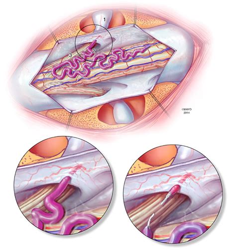 Dural arteriovenous fistulas | Brazil| PDF | PPT| Case Reports | Symptoms | Treatment