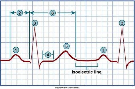 The ECG tracing as seen in normal sinus rhythm. 1, P wave; 2, PR interval; 3, QRS complex: Q ...