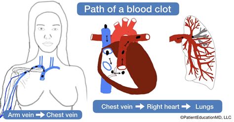 Blood clot in the arm - PatientEducationMD