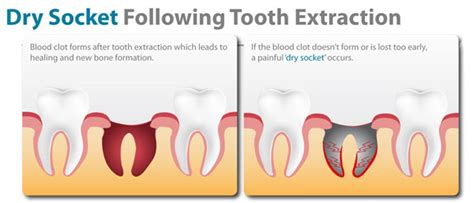 What is a dry socket? – Causes and Prevention - Wisdom Dental Emergency