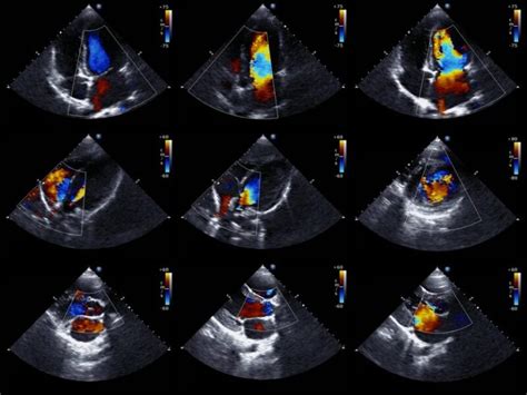 Echocardiogram : Definition, Uses, procedure & Side effects - Irving ...