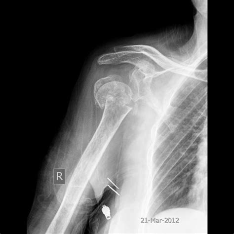 Humeral surgical neck fracture | Radiology Case | Radiopaedia.org