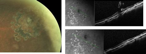 A Field Guide to Retinal Holes and Tears