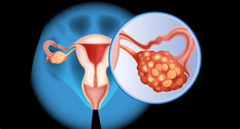 Ovarian Cancer Tumor Types