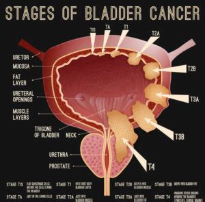 BLADDER CANCER – Africa Cancer Hub