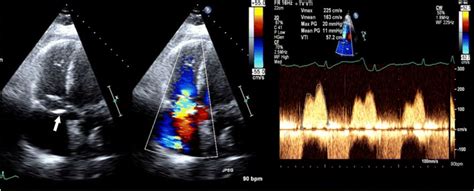 Tricuspid stenosis echocardiography and ultrasound - wikidoc