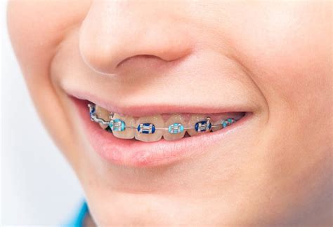 Braces for Children's Teeth - Cost, Types and more