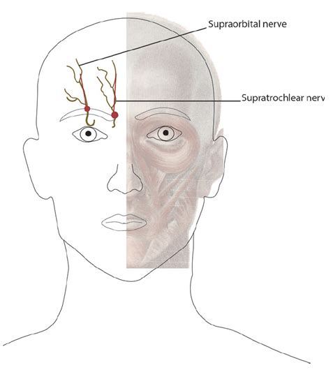 Procedural Treatments for Headache Disorders - Practical Neurology