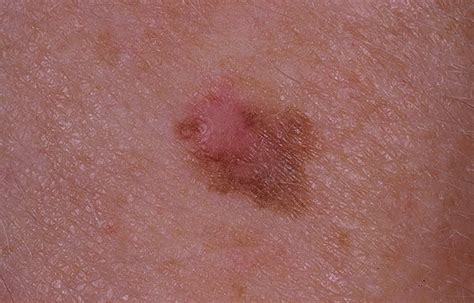 Early Melanoma Pictures – 54 Photos & Images / illnessee.com