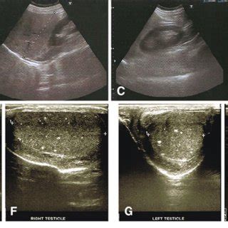 a–d Breast ultrasound scan showing bilateral gynecomastia in patient 1... | Download Scientific ...