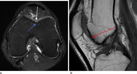 MRI of the left knee with axial proton density-weighted fat-suppressed ...