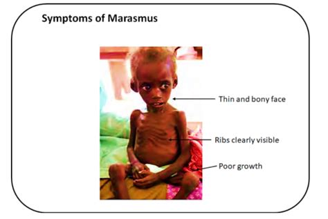 Kwashiorkor And Marasmus