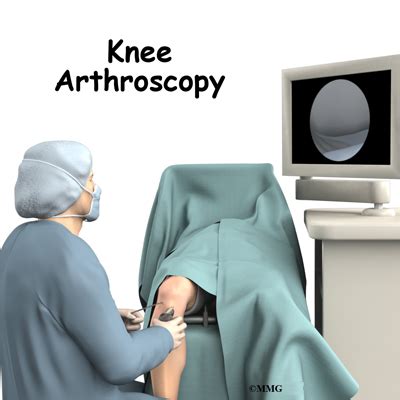 Knee Arthroscopy | eOrthopod.com