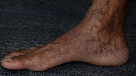 Dark Veins On Foot Sale Online | emergencydentistry.com