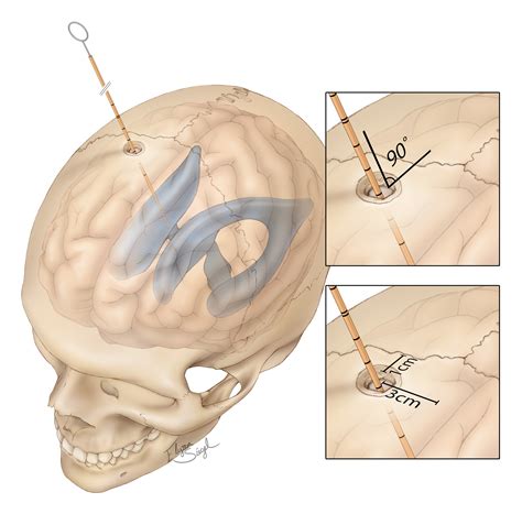 External Ventricular Drain | The Neurosurgical Atlas