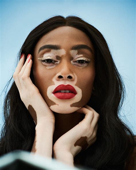 The Best Skin Care Tips for Vitiligo, From Top Derms | Winnie harlow, Vitiligo model, Drawing people