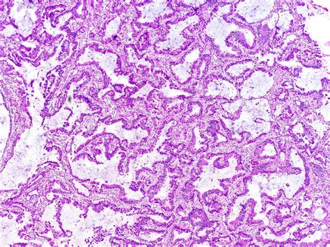 Lung Carcinoma Histology