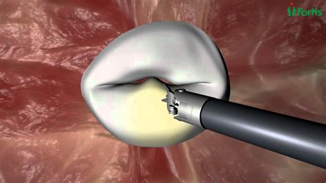 Endoscopic Mitral Valve Repair Procedure Animation - YouTube