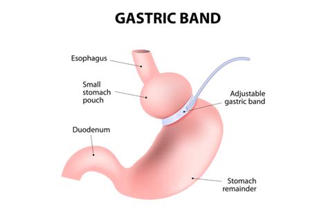 Gastric Banding - Dr. Mario Camelo